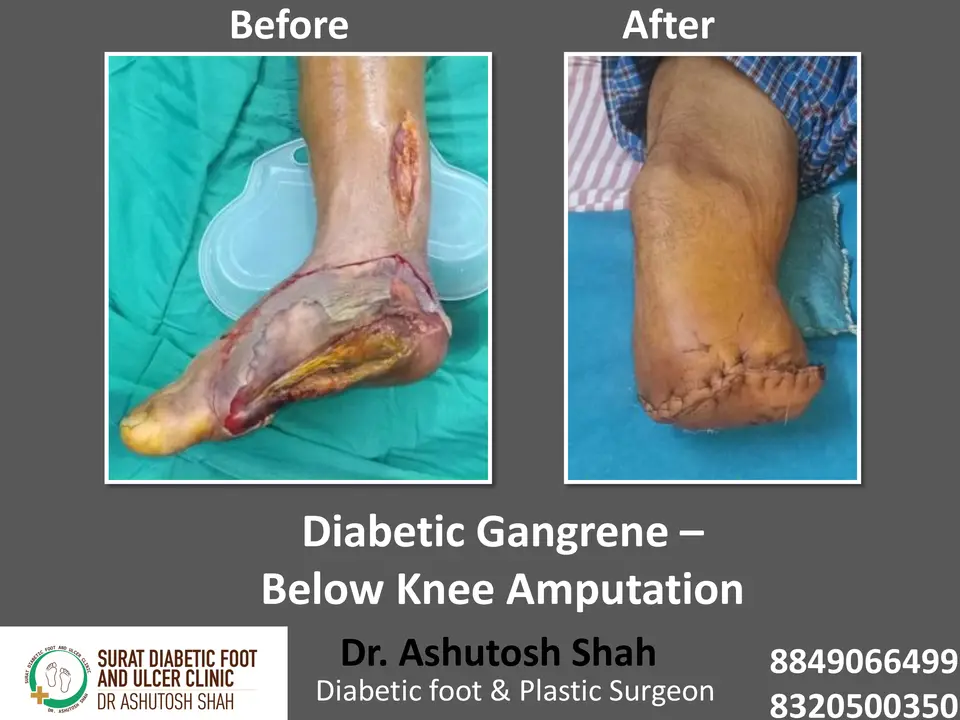 Diabetic Foot  PPT sunita.pptx-36.webp